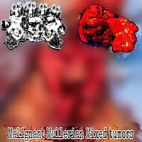 Malignant Mullerian Mixed Tumors